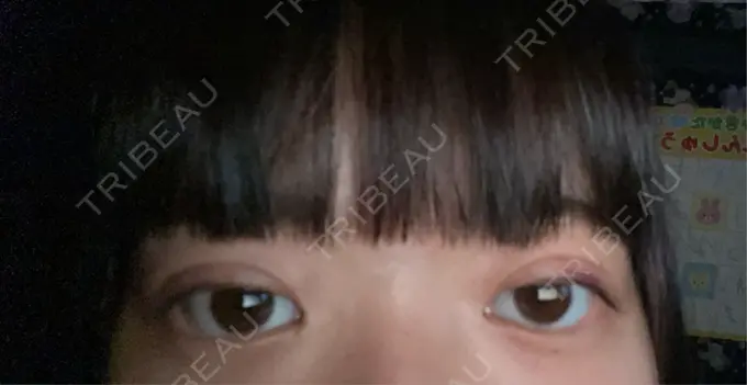 二重埋没 アリエル美容クリニック 郡山院 DAY 1 メイン用