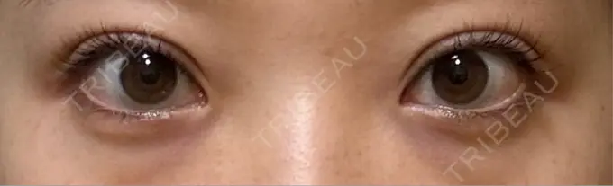 二重埋没 / 上まぶたたるみ取り 湘南美容クリニック 池袋東口院 DAY 13 メイン用