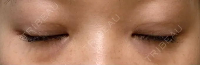 二重埋没 / 上まぶたたるみ取り 湘南美容クリニック 池袋東口院 DAY 13 メイン用