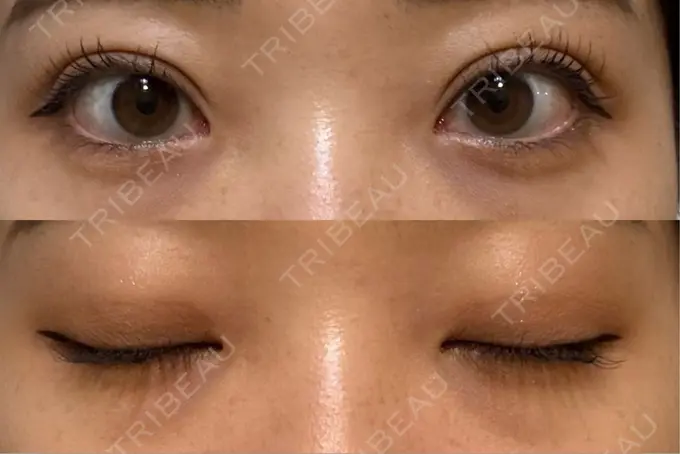 二重埋没 / 上まぶたたるみ取り 湘南美容クリニック 池袋東口院 DAY 13 メイン用