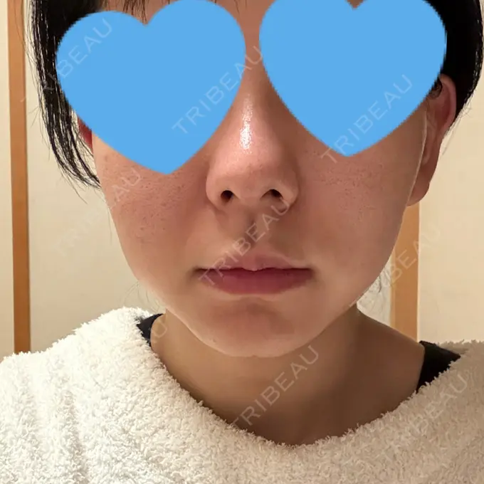 ヒアルロン酸注入（鼻） / ボトックス（エラ・小顔） / ヒアルロン酸注入（唇） / 美容点滴・美容注射（美肌） / ヒアルロン酸注入（鼻翼基部） HAAB BEAUTY CLINIC 名古屋院 AFTER メイン用