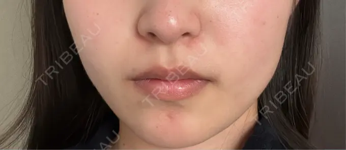 ボトックス（エラ・小顔） 共立美容外科 千葉院 DAY 6 メイン用