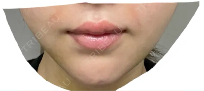 あごプロテーゼ ルラ美容クリニック 渋谷本院 AFTER メイン用