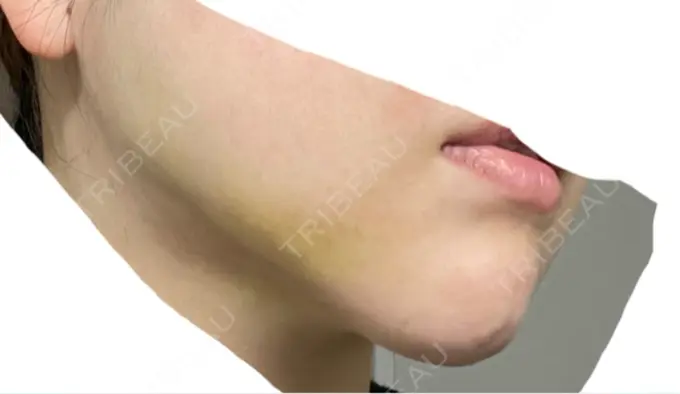 あごプロテーゼ ルラ美容クリニック 渋谷本院 DAY 504 メイン用