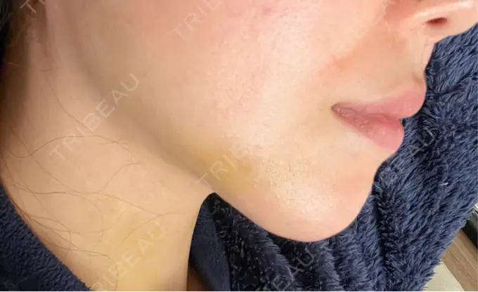 あごプロテーゼ ルラ美容クリニック 渋谷本院 DAY 504 メイン用