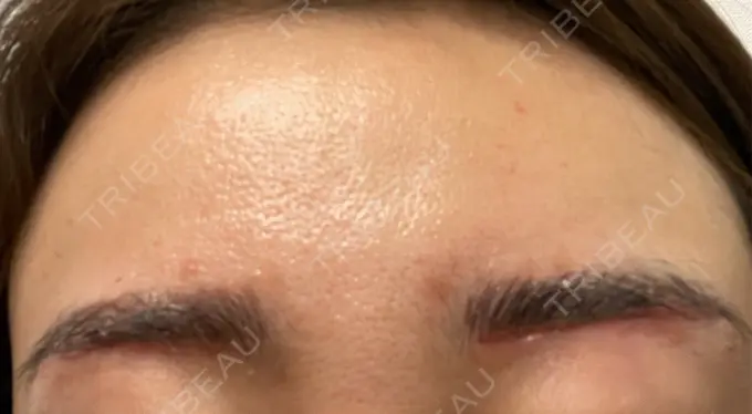 アートメイク（眉） しんゆり美容健康クリニック DAY 1 メイン用