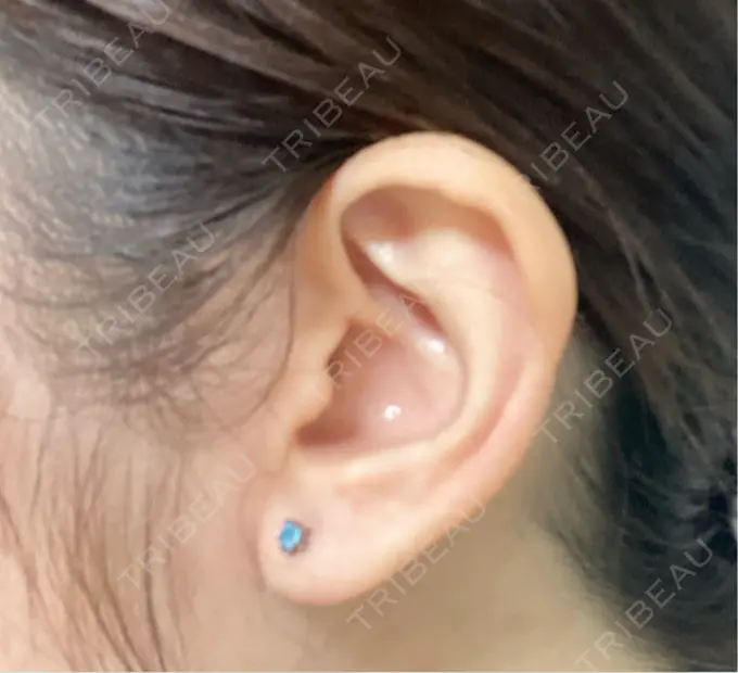 ピアス穴あけ 新宿ラクル美容外科クリニック 新宿院 AFTER メイン用