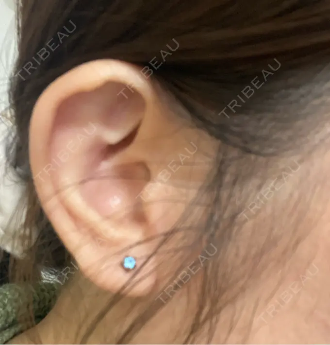 ピアス穴あけ 新宿ラクル美容外科クリニック 新宿院 DAY 24 メイン用