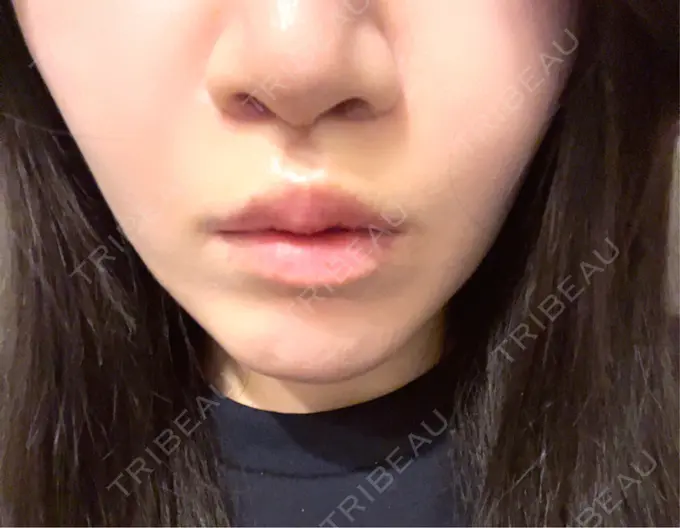 人中短縮 / 鼻柱下降・鼻唇角形成（猫手術） / その他（鼻） Otus Clinic 【オータスクリニック】 DAY 23 メイン用