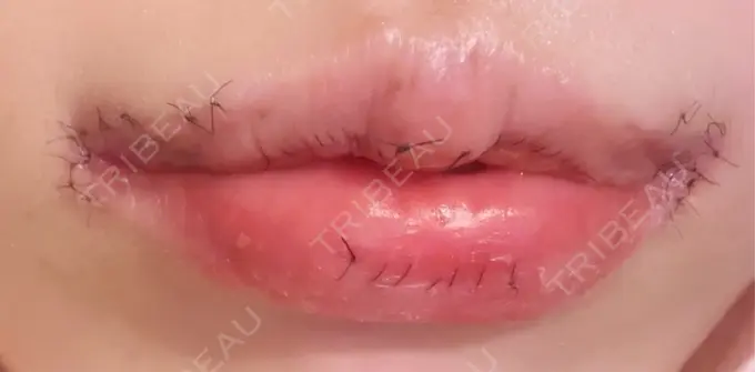 口角挙上 / その他（口元） R Beauty CLINIC 銀座院 DAY 5 メイン用