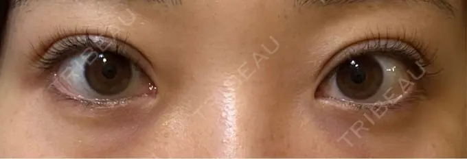 二重埋没 / 上まぶたたるみ取り 湘南美容クリニック 池袋東口院 DAY 14 メイン用