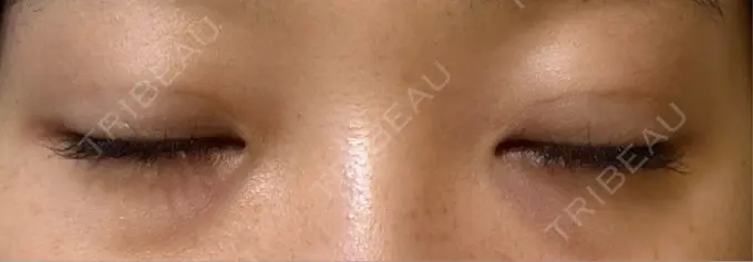 二重埋没 / 上まぶたたるみ取り 湘南美容クリニック 池袋東口院 DAY 14 メイン用