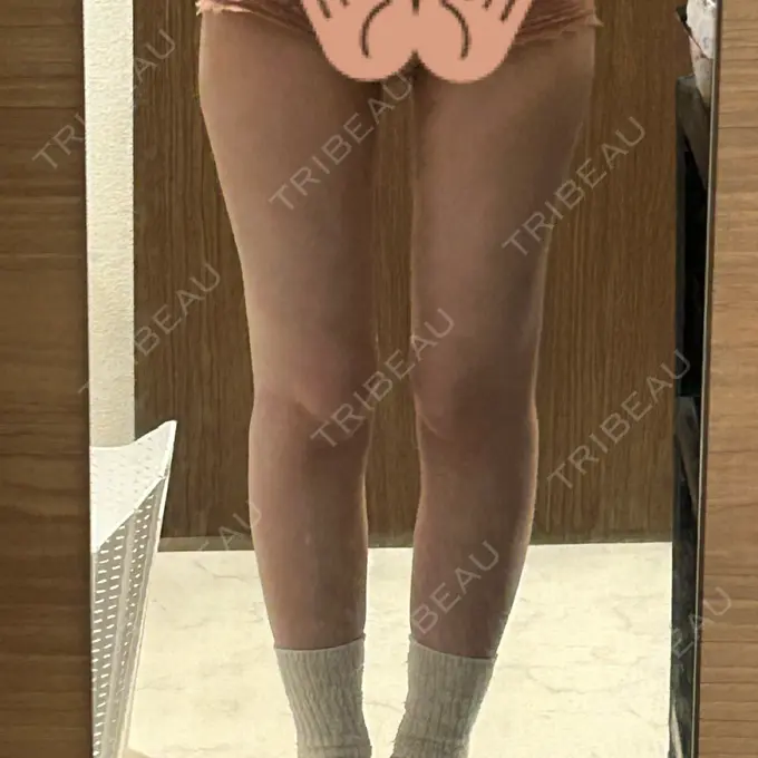 脂肪吸引（脚） Mods Clinic（モッズクリニック） 名古屋院 DAY 157 メイン用