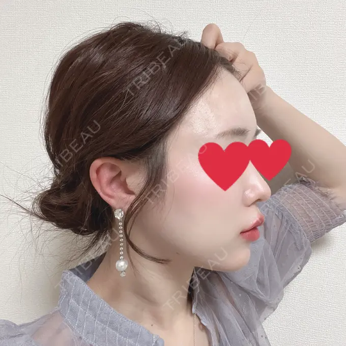 ヒアルロン酸注入（あご） / ヒアルロン酸注入（唇） / ヒアルロン酸注入（額） / ヒアルロン酸注入（頬） / ヒアルロン酸注入（鼻翼基部） シェリークリニック 渋谷院 AFTER メイン用