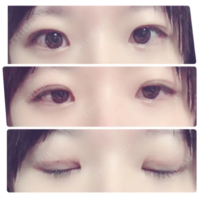 二重切開 / 上まぶたの脂肪取り 聖心美容クリニック 横浜院 AFTER メイン用