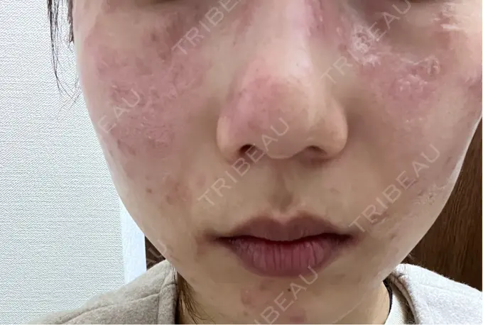 ピコスポット 東京シルククリニック 新宿院 DAY 0 メイン用