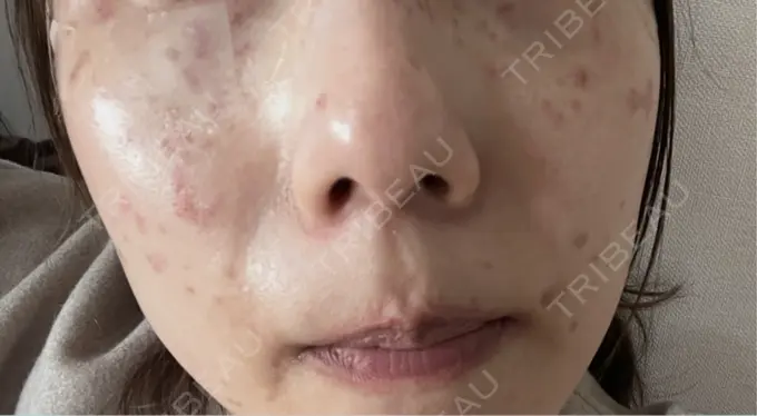 ピコスポット 東京シルククリニック 新宿院 DAY 0 メイン用