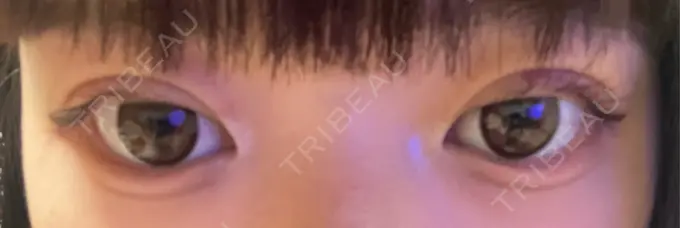 二重埋没 アリエル美容クリニック 郡山院 DAY 4 メイン用