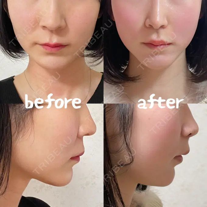 小鼻縮小（切開） / 人中短縮 / 鼻翼挙上 / 鼻翼基部形成（貴族手術） / 鼻柱下降・鼻唇角形成（猫手術） Otus Clinic 【オータスクリニック】 DAY 56 メイン用