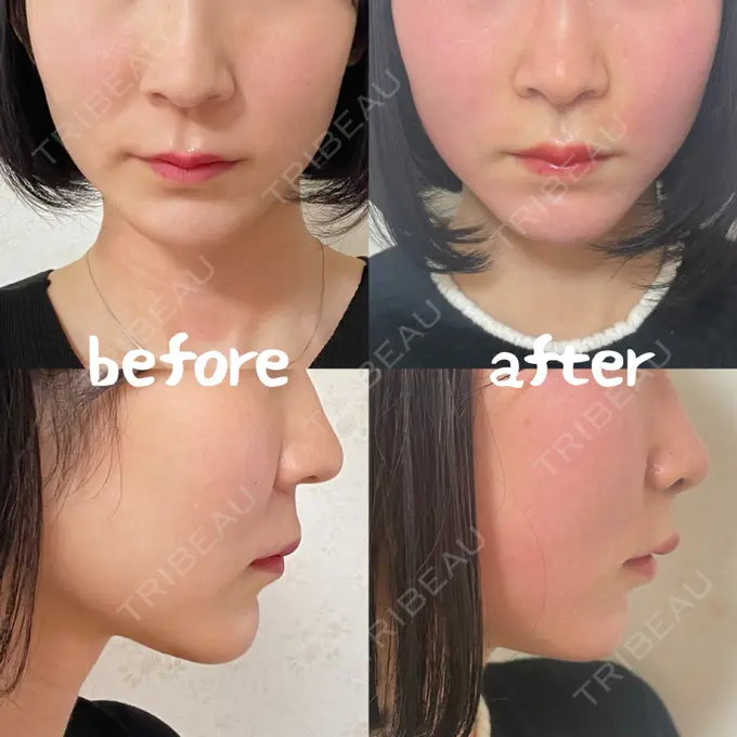 小鼻縮小（切開） / 人中短縮 / 鼻翼挙上 / 鼻翼基部形成（貴族手術） / 鼻柱下降・鼻唇角形成（猫手術） Otus Clinic 【オータスクリニック】 DAY 32 メイン用