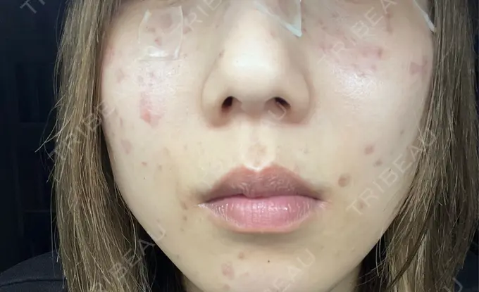 ピコスポット 東京シルククリニック 新宿院 DAY 1 メイン用