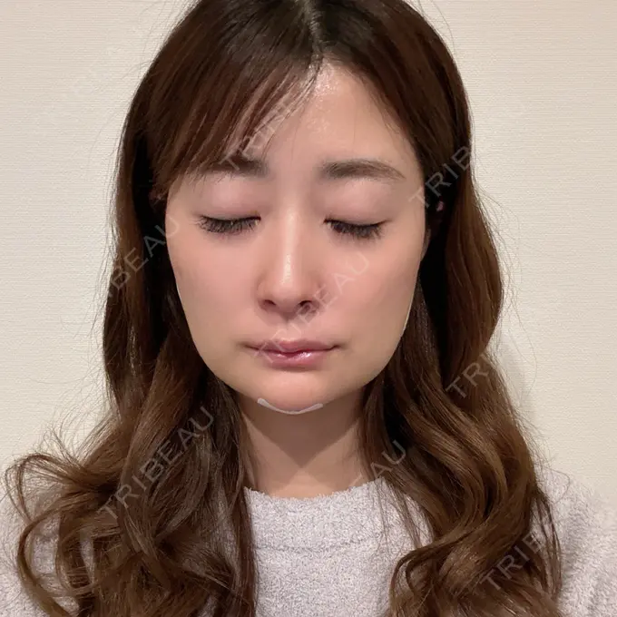 糸リフト / ジョールファット除去 / 脂肪吸引注射（顔） / ボトックス（エラ・小顔） / 脂肪注入（輪郭） ICON CLINIC DAY 3 メイン用