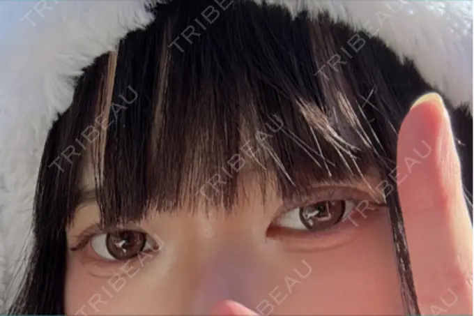 二重埋没 アリエル美容クリニック 郡山院 DAY 5 メイン用