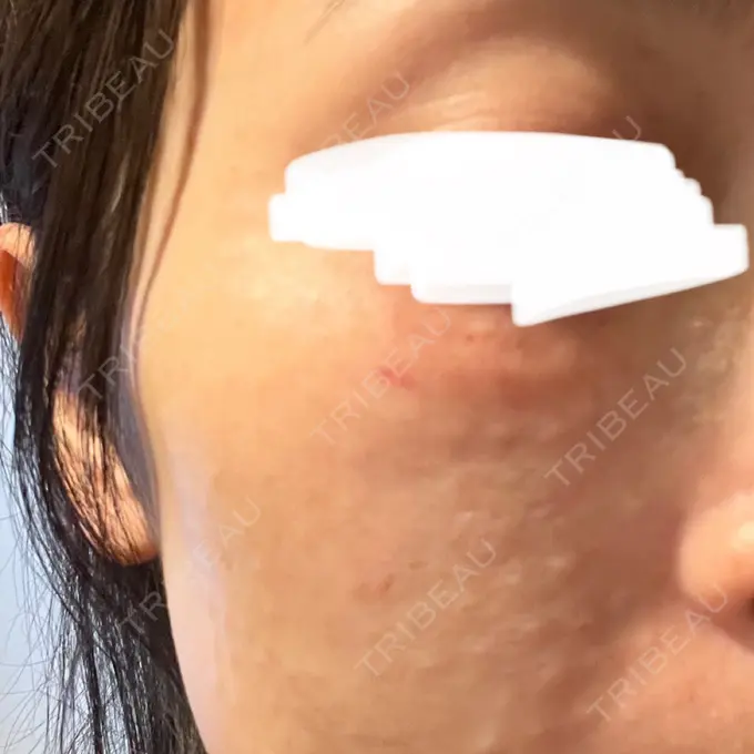 リジュラン しんゆり美容健康クリニック DAY 0 メイン用