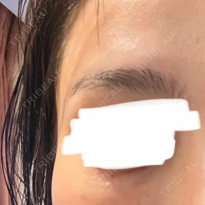 リジュラン しんゆり美容健康クリニック DAY 2 メイン用