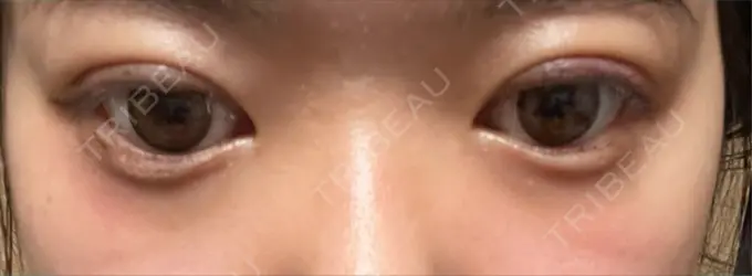 二重埋没 アリエル美容クリニック 郡山院 DAY 6 メイン用