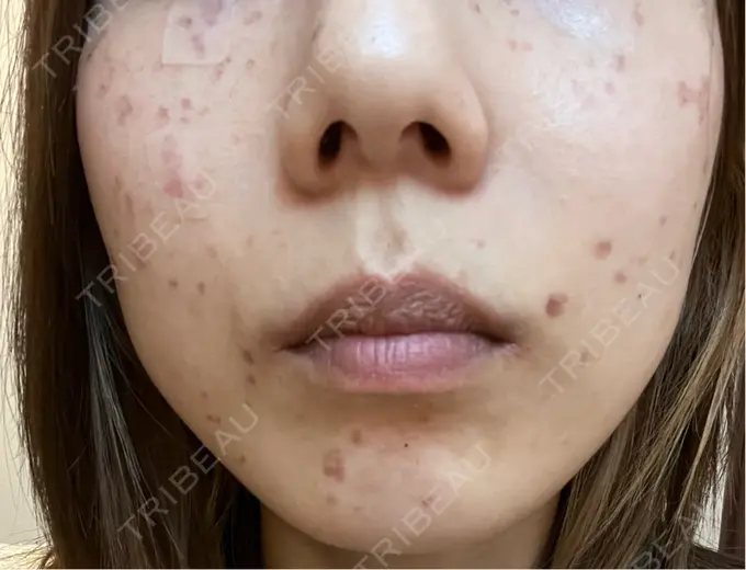 ピコスポット 東京シルククリニック 新宿院 DAY 2 メイン用