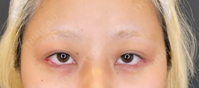 目尻切開 / タレ目形成・グラマラスライン（埋没） / ボトックス（エラ・小顔） LOUIS CLINIC 二子玉川院【ルイクリニック】 DAY 0 メイン用