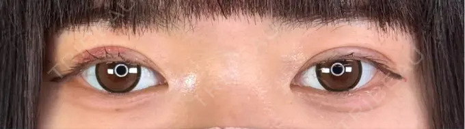 二重埋没 アリエル美容クリニック 郡山院 DAY 7 メイン用