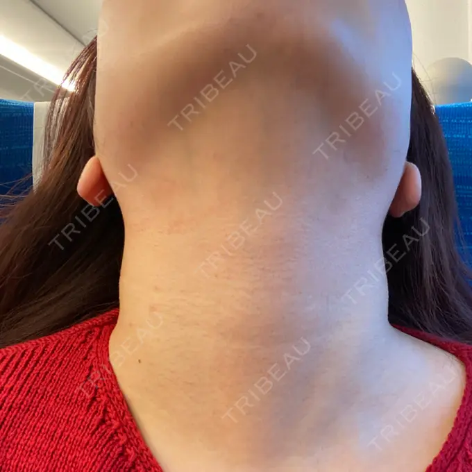 RF（高周波）たるみ治療 表参道メディカルクリニック 表参道院 DAY 2 メイン用