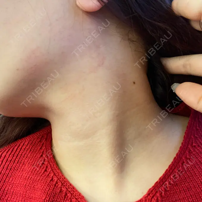 RF（高周波）たるみ治療 表参道メディカルクリニック 表参道院 DAY 2 メイン用