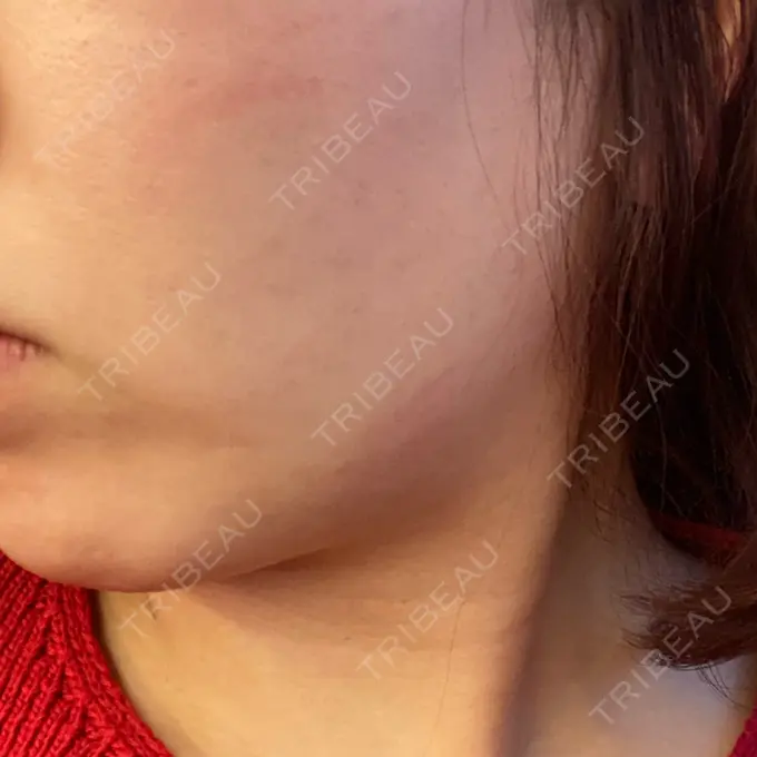 RF（高周波）たるみ治療 表参道メディカルクリニック 表参道院 DAY 2 メイン用