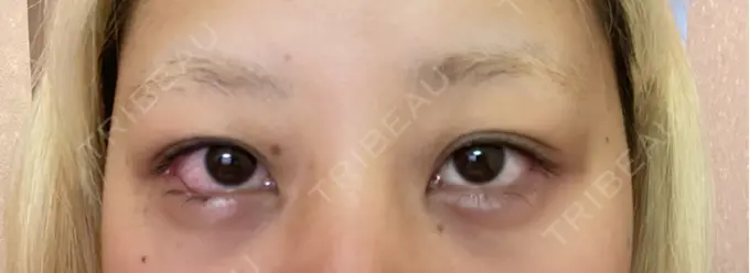 目尻切開 / タレ目形成・グラマラスライン（埋没） / ボトックス（エラ・小顔） LOUIS CLINIC 二子玉川院【ルイクリニック】 DAY 1 メイン用