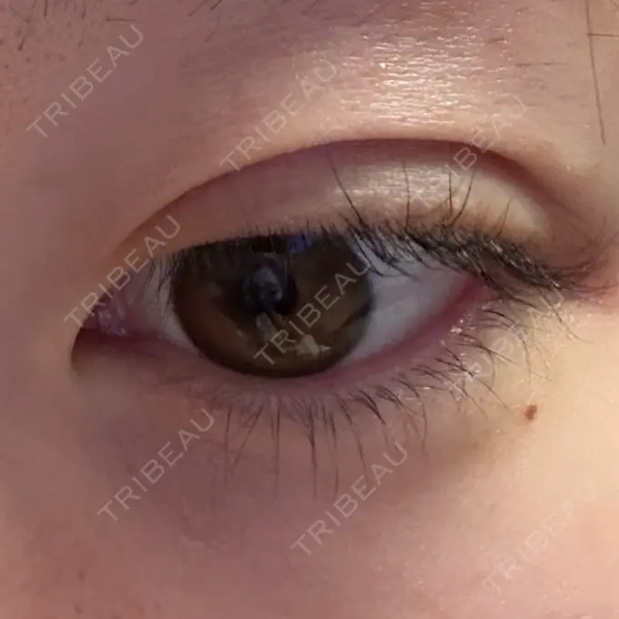 二重埋没 高須クリニック 名古屋院 DAY 0 メイン用