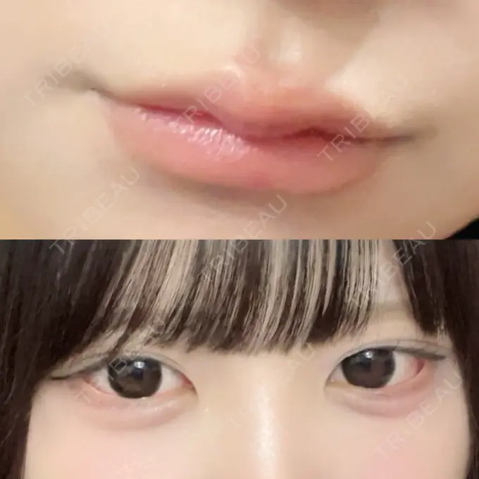 ヒアルロン酸注入（涙袋） / ヒアルロン酸注入（唇） HAAB×DREAM BEAUTY CLINIC 大阪梅田院 DAY 1 メイン用