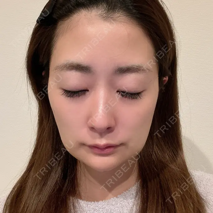 糸リフト / ジョールファット除去 / 脂肪吸引注射（顔） / ボトックス（エラ・小顔） / 脂肪注入（輪郭） ICON CLINIC DAY 4 メイン用