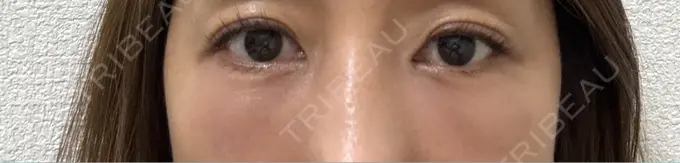 クマ治療 / 下まぶたの脂肪取り / ヒアルロン酸注入（目の下） / その他（目元） ROOTS Clinic DAY 1 メイン用