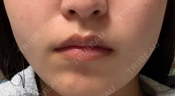 ボトックス（エラ・小顔） 共立美容外科 千葉院 DAY 11 メイン用