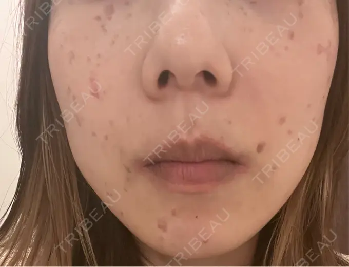 ピコスポット 東京シルククリニック 新宿院 DAY 3 メイン用