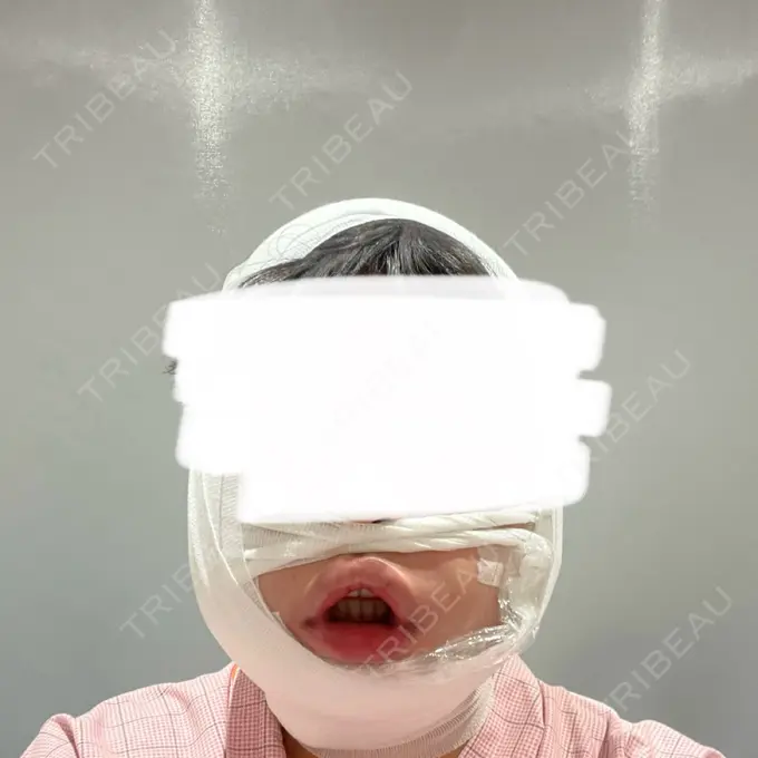 糸リフト / 脂肪吸引（顔） Otus Clinic 【オータスクリニック】 DAY 0 メイン用