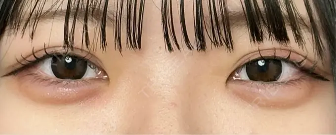 ヒアルロン酸注入（涙袋） / ヒアルロン酸注入（唇） 仙台N美容クリニック AFTER メイン用