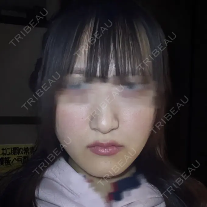 骨切り（あご） 銀座マイアミ美容外科 DAY 315 メイン用