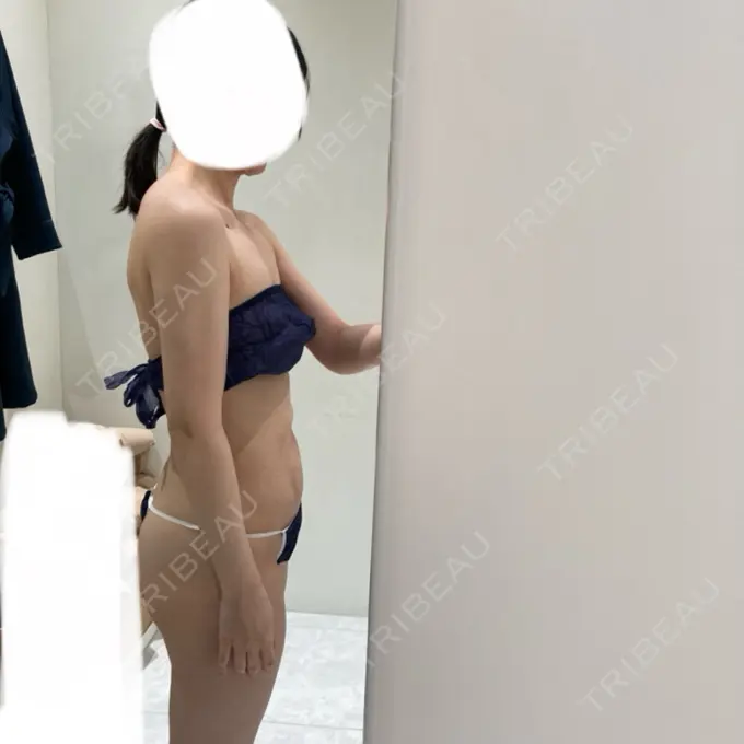 脂肪吸引（顔） / 脂肪吸引（二の腕） / 医療痩身（お腹） / 脂肪吸引（腰） / 脂肪吸引（肩） Mods Clinic（モッズクリニック） 福岡院 DAY 100 メイン用