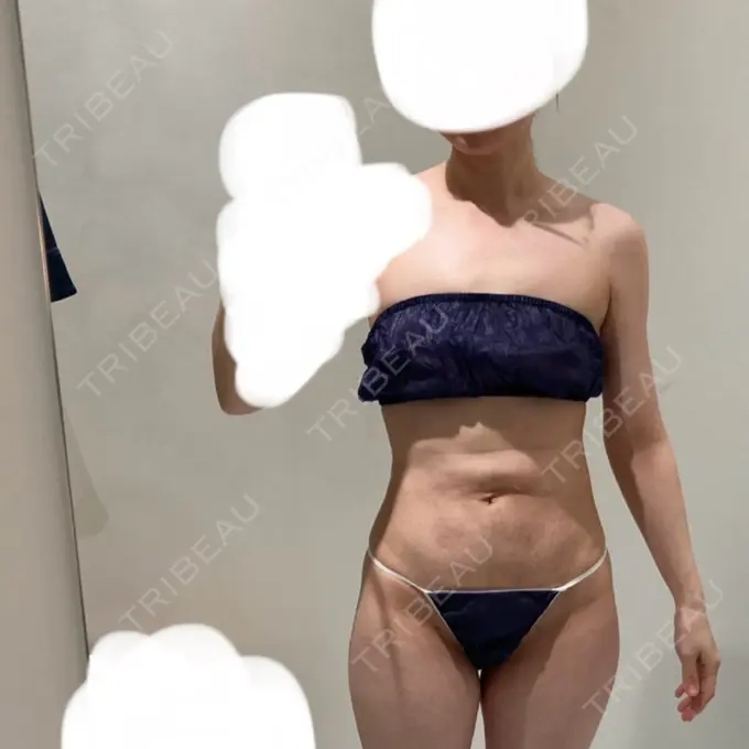 脂肪吸引（顔） / 脂肪吸引（二の腕） / 医療痩身（お腹） / 脂肪吸引（腰） / 脂肪吸引（肩） Mods Clinic（モッズクリニック） 福岡院 DAY 100 メイン用