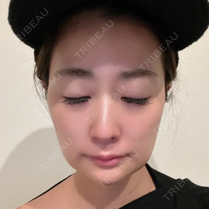 糸リフト / ジョールファット除去 / 脂肪吸引注射（顔） / ボトックス（エラ・小顔） / 脂肪注入（輪郭） ICON CLINIC DAY 5 メイン用