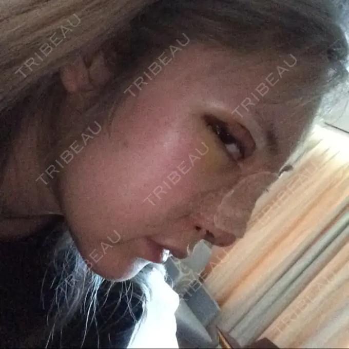 鼻尖形成（切開） / 鼻中隔延長（切開） / 眉間プロテーゼ / 鼻修正 FROM B整形外科 (旧バウム整形外科) DAY 3 メイン用